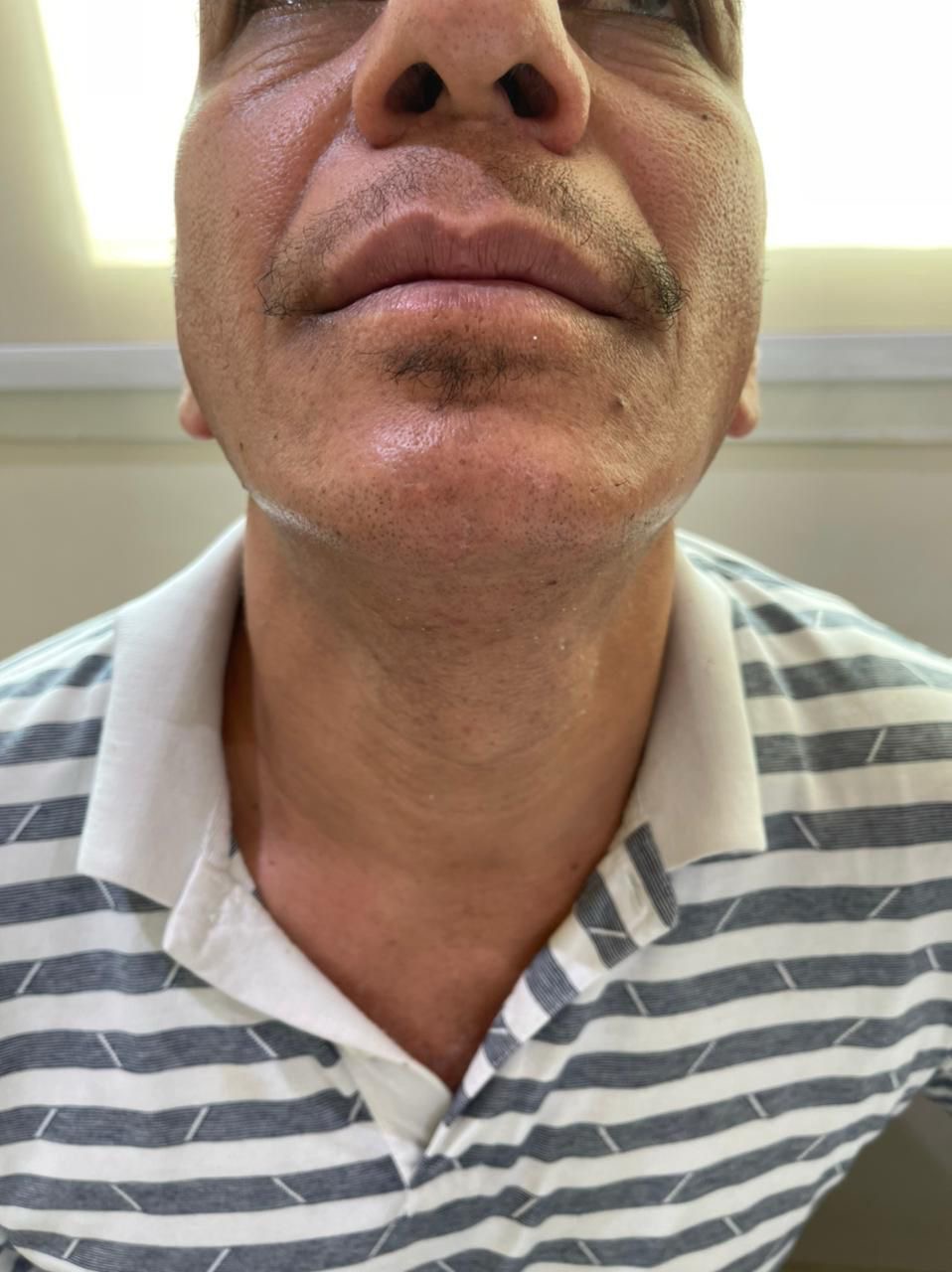 Chin Scar Revision — after