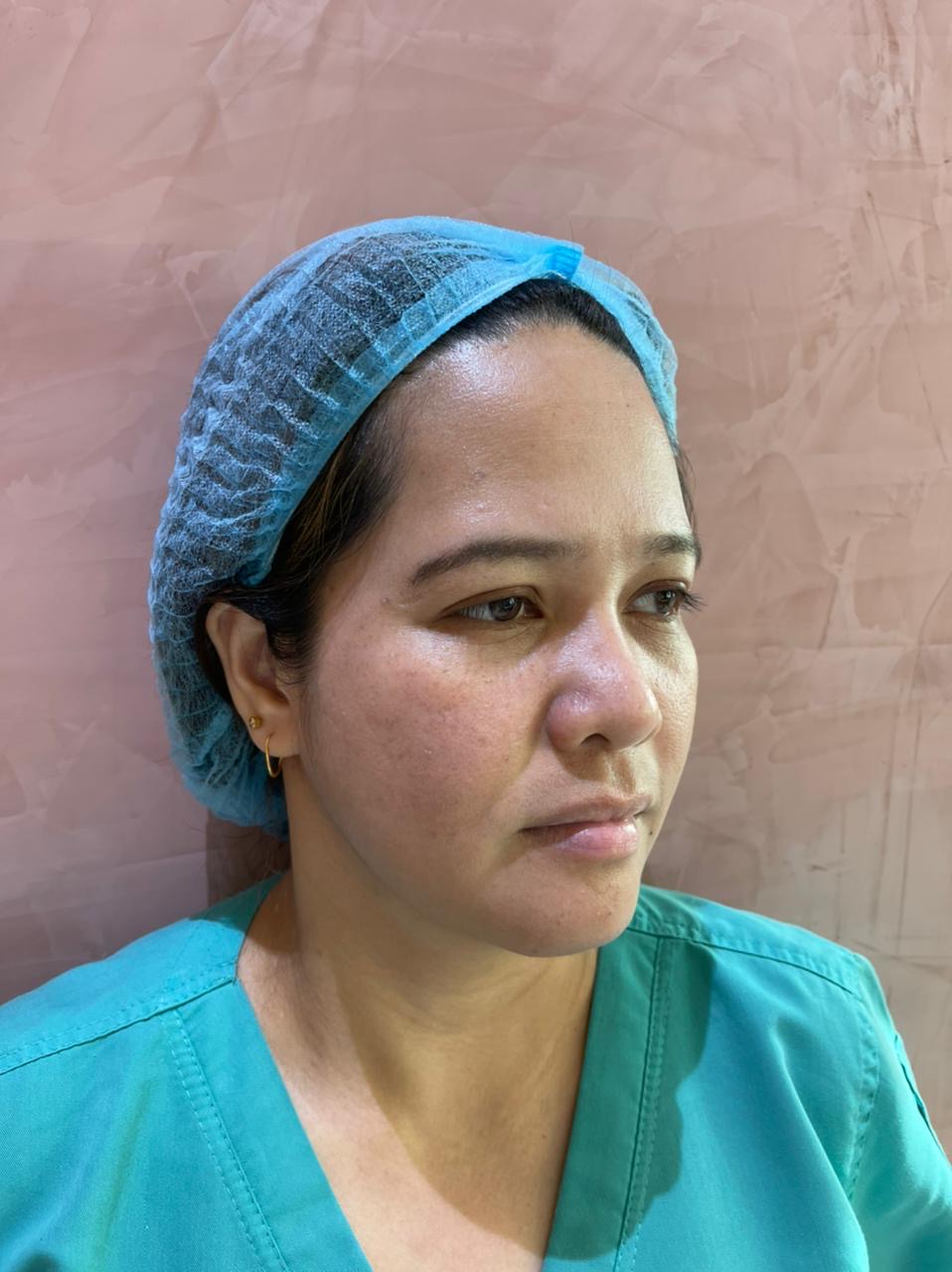 Erbium YAG Fractional Laser — after