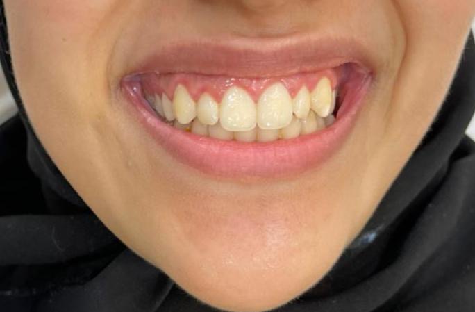 BOTOX Gummy Smile Correction — before