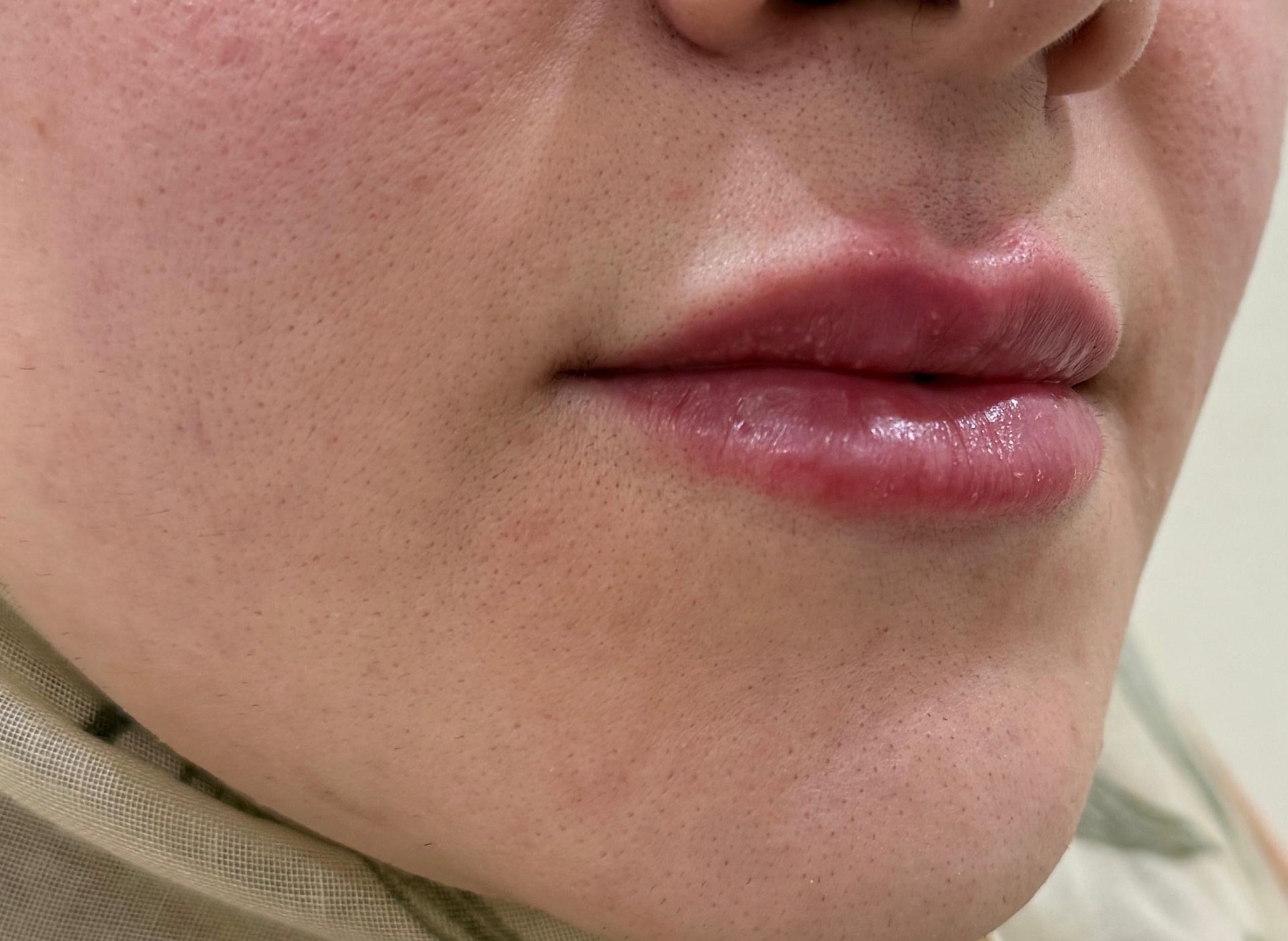 Lip Enhancement with Filler — after