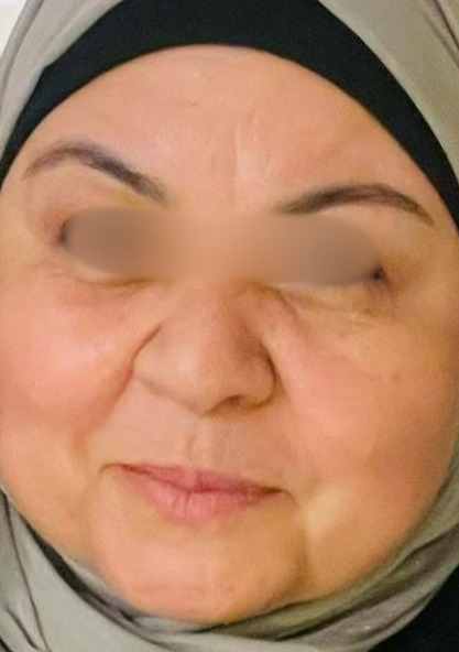 Face Lifting — Hybrid Filler (SFERA) — after