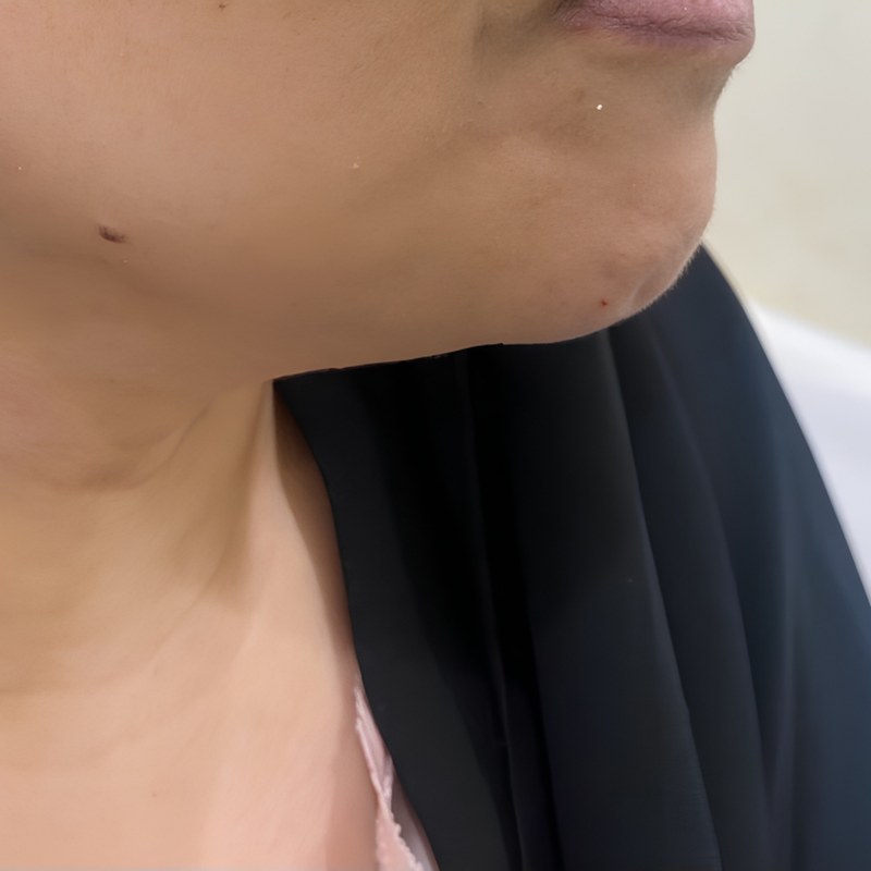 Neck Lift & Double Chin Correction (SCULPTRA) — after