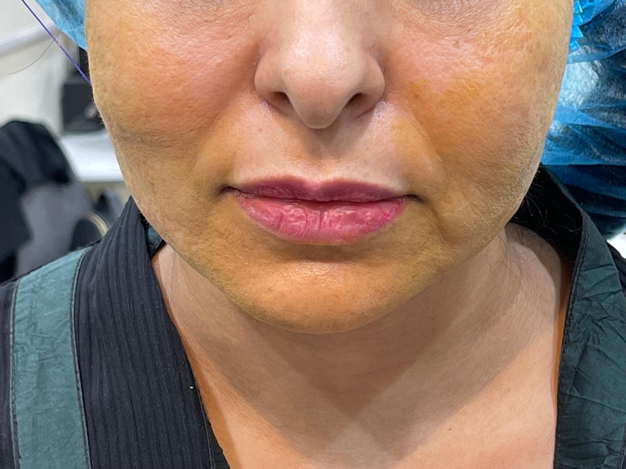 Thread Lifting — Facial Sagging — before