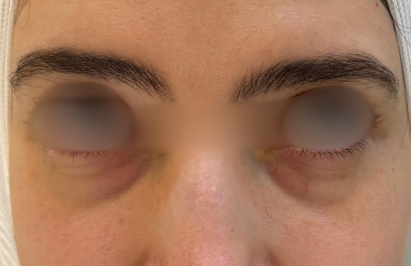Filler Tear-Trough Treatment — before