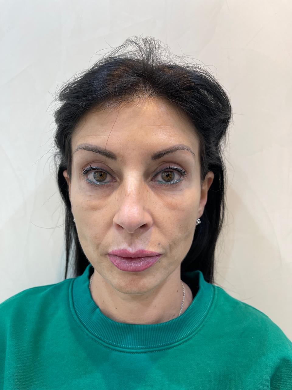 Filler — Full Face Volume & Lifting — before