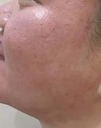 TCA Cross + Fractional Erbium YAG Laser — after