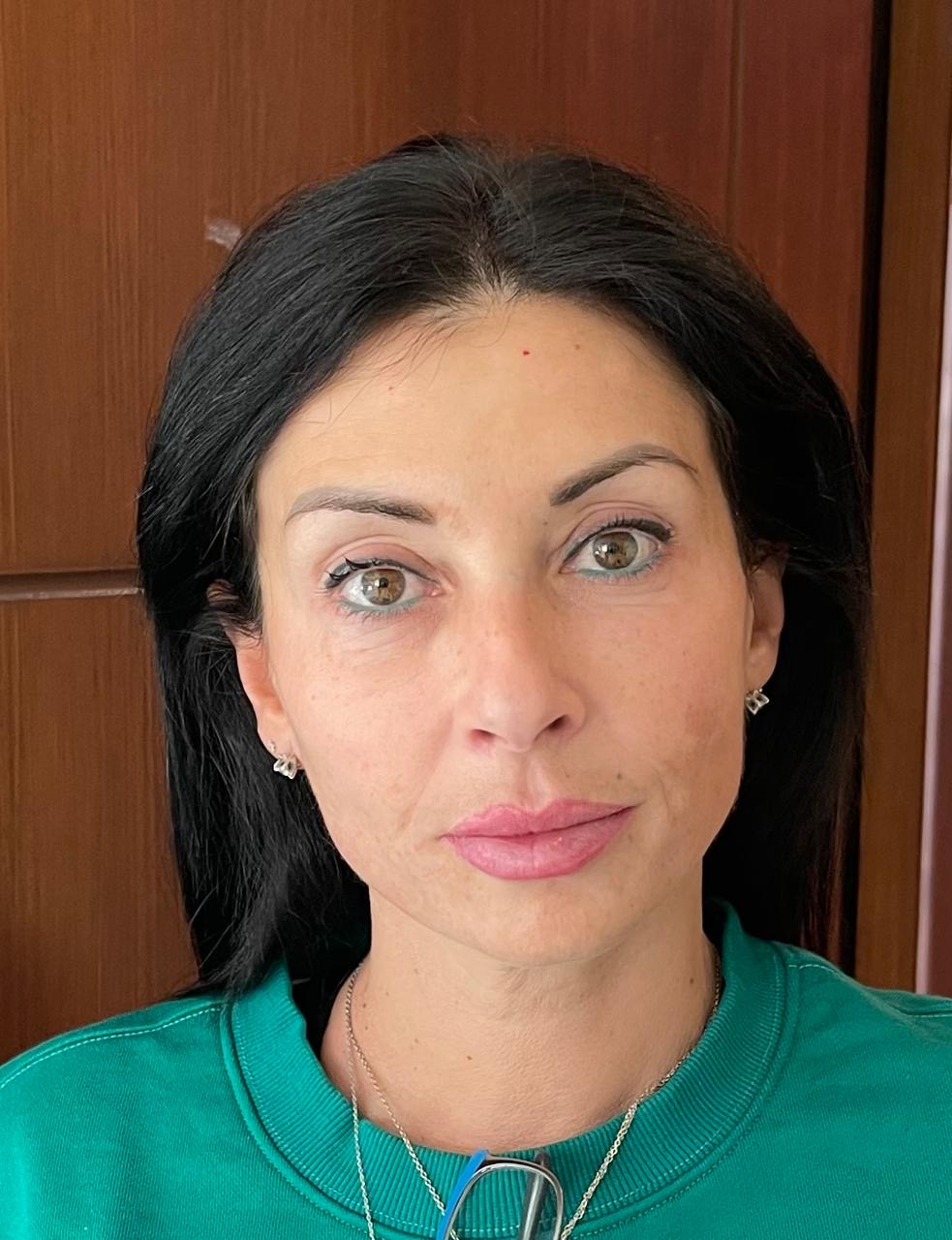 Filler — Full Face Volume & Lifting — after