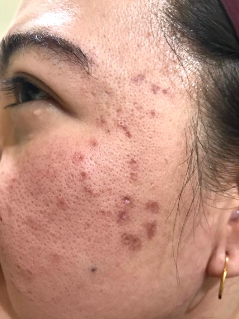 TCA Cross + Fractional Erbium YAG Laser — before