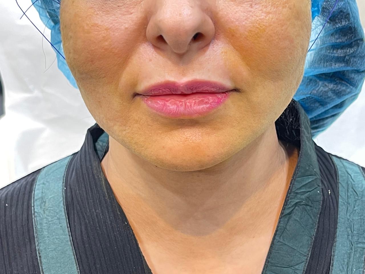 Thread Lifting — Facial Sagging — after