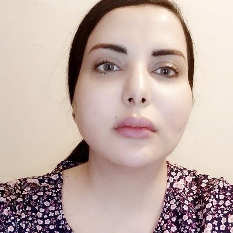 Thread Lifting — Face — after