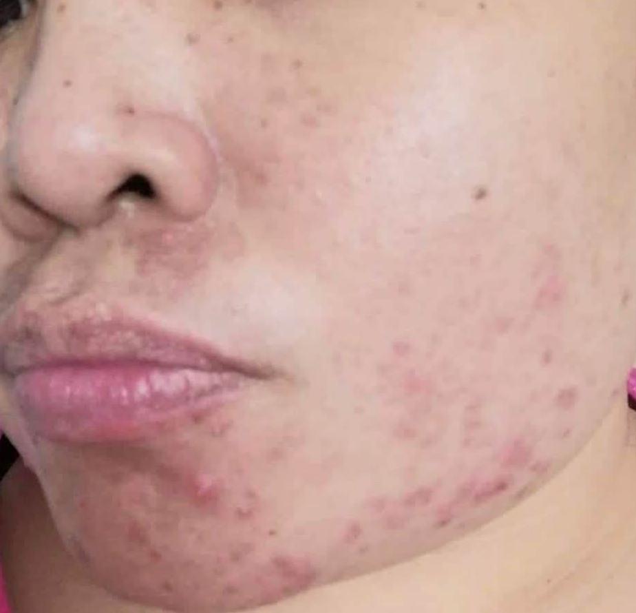 Active Acne & Redness — before