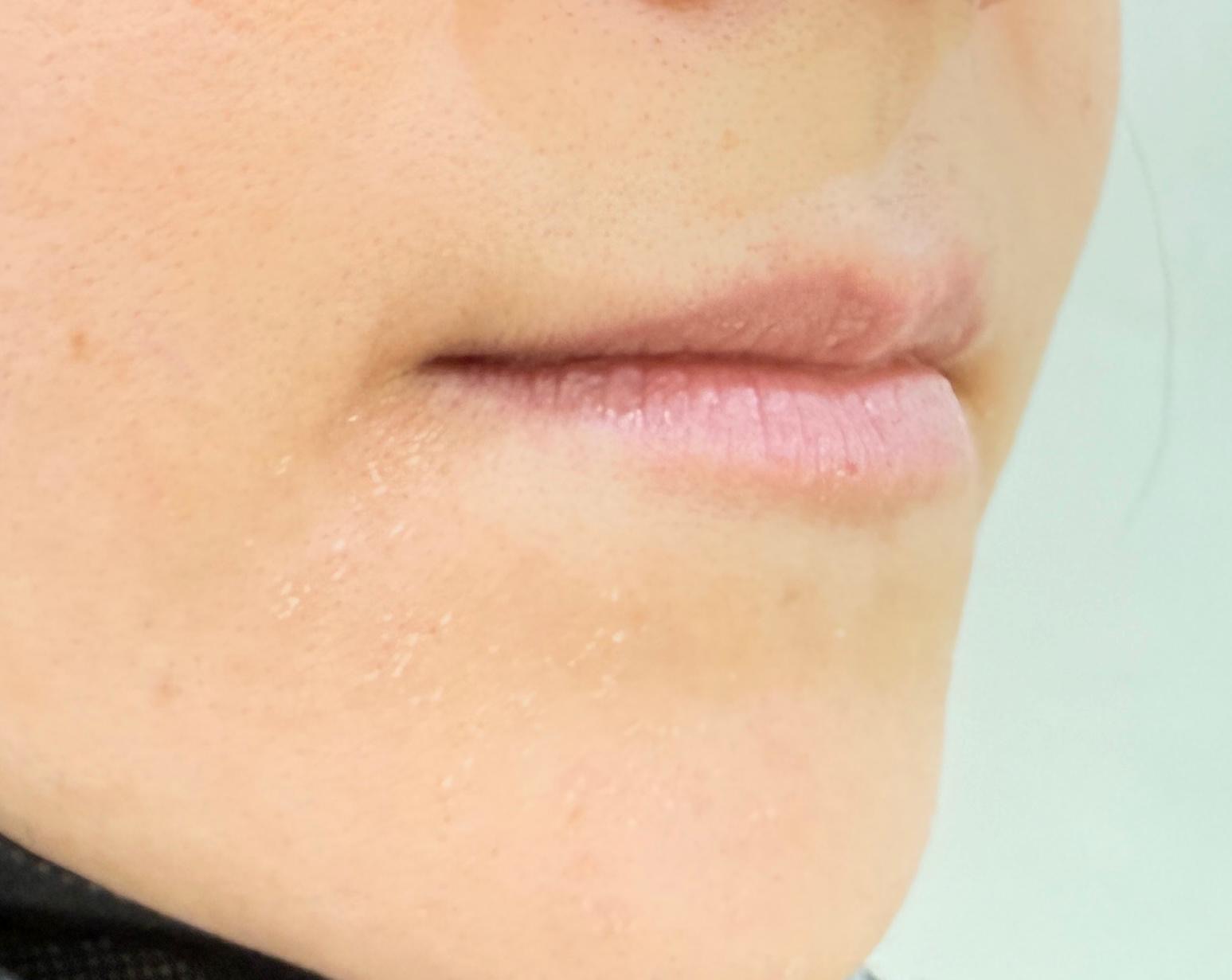 Lip Enhancement with Filler — before