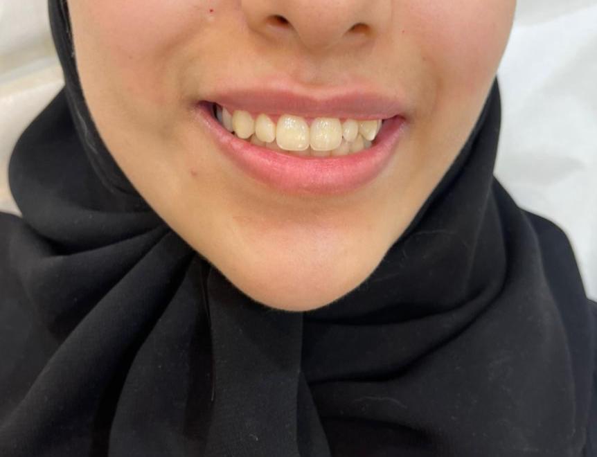 BOTOX Gummy Smile Correction — after