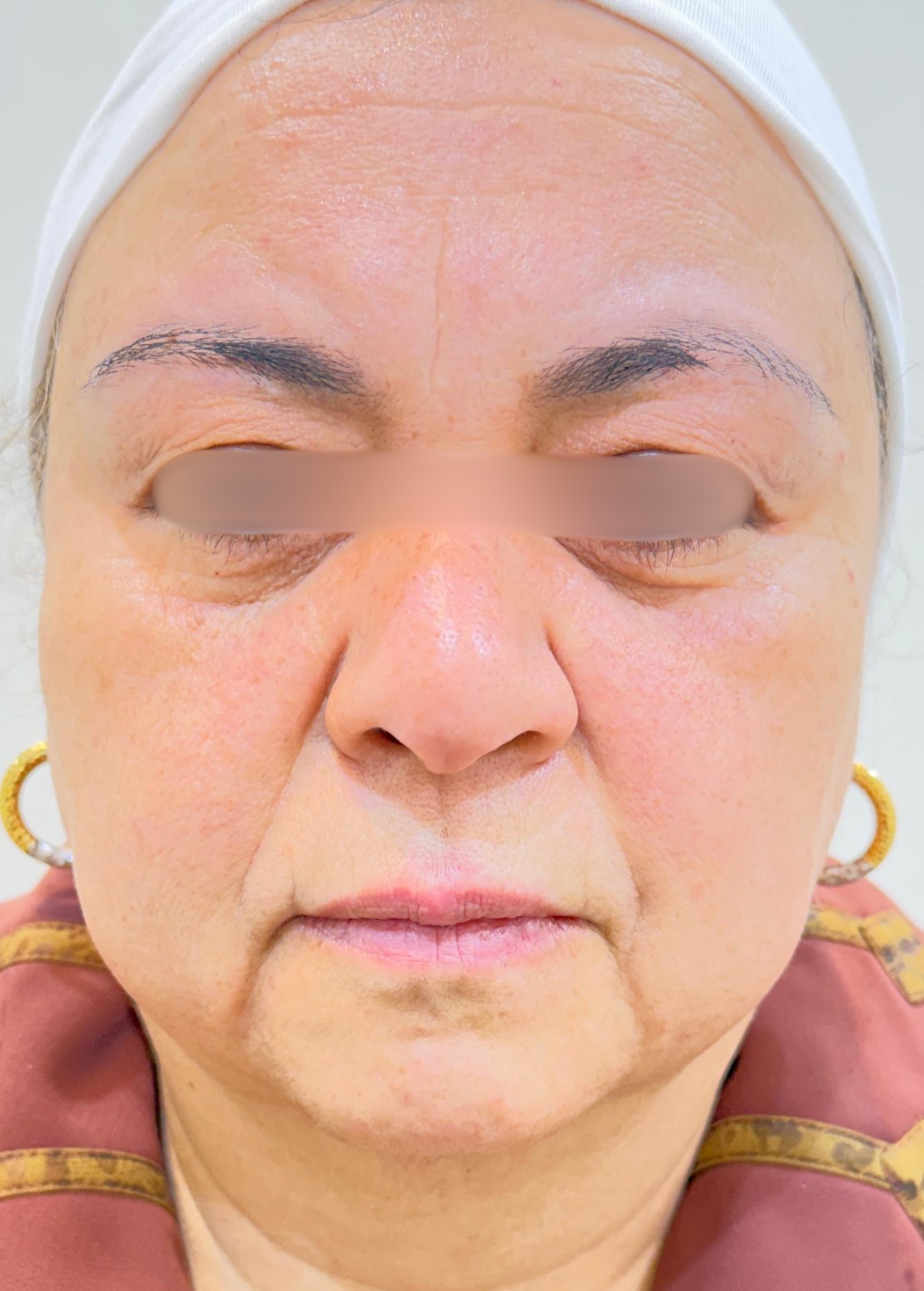Face Lifting — Hybrid Filler (SFERA) — before